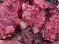 Эхинококкоз печени у человека: фото и симптомы